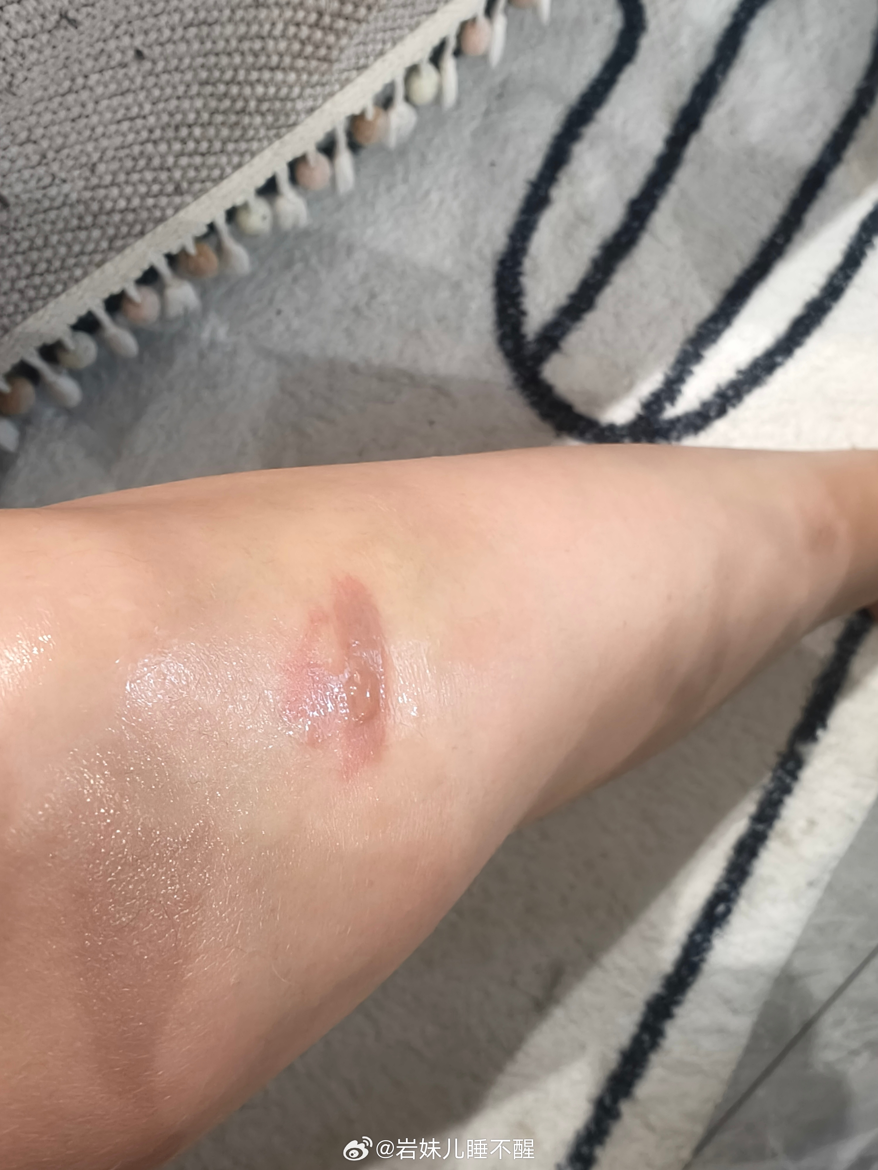 腿被烧烤签扎伤周围肿胀，正确处理与护理指南