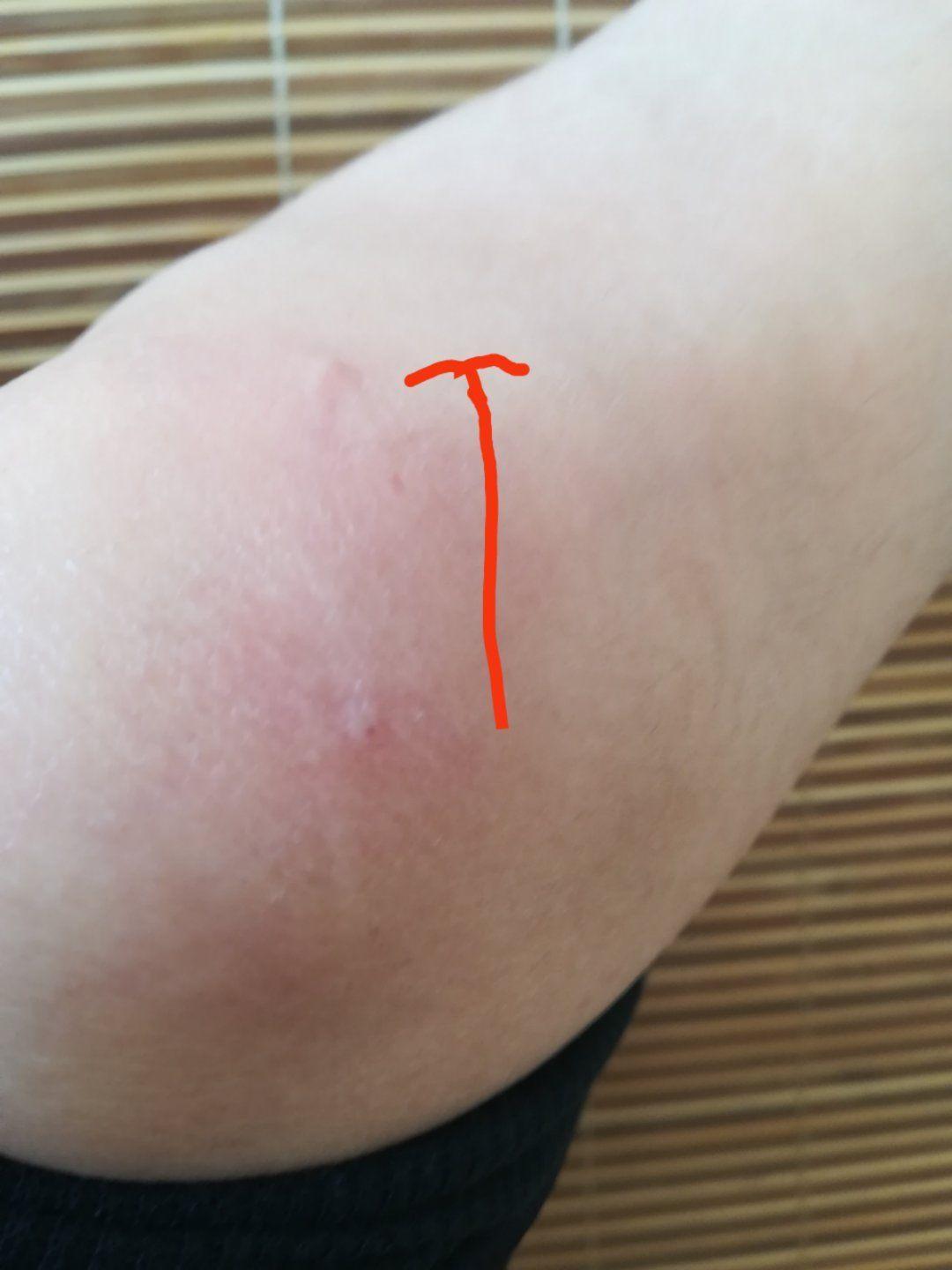 腿被烧烤签子扎伤引发肿块，全面解析与处理指南