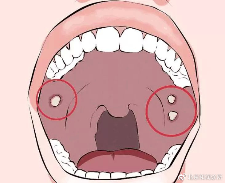 口腔溃疡与HPV，并非直接相关
