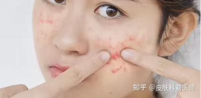 揭秘春天为何成为痘痘高发期