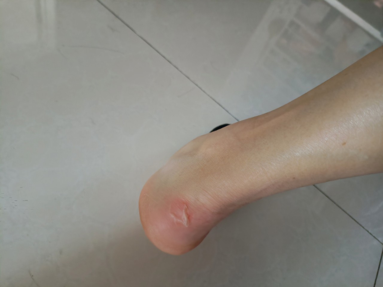 女生穿鞋磨脚怎么办？十招解决你的烦恼！