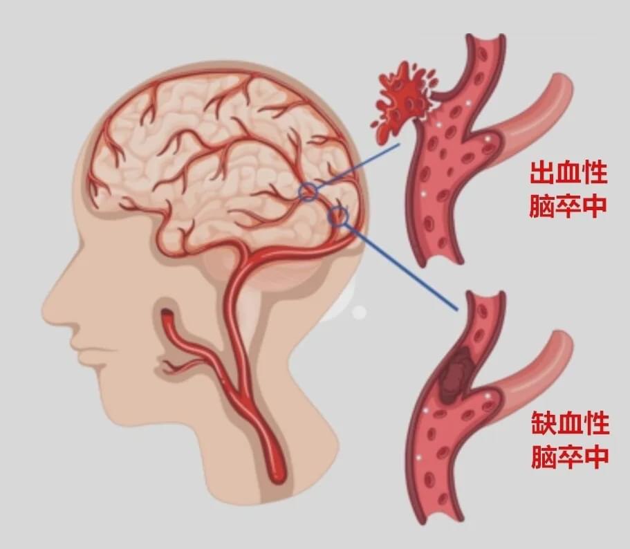 脑干出血宣布死亡还有奇迹吗？探寻生与死的边界