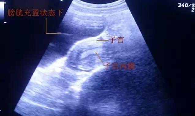 憋尿把膀胱憋坏了怎么办？全面解析应对之策