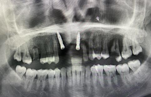 70岁大爷一口烂牙引发肺部空洞，口腔健康与全身健康的紧密关联
