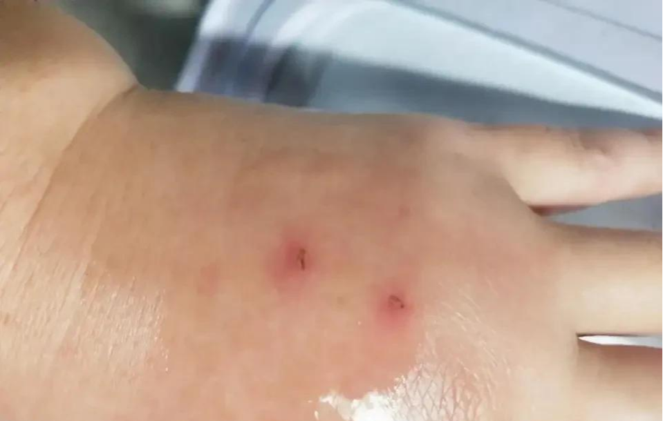 蛇咬之痛，伤口多年后的余悸