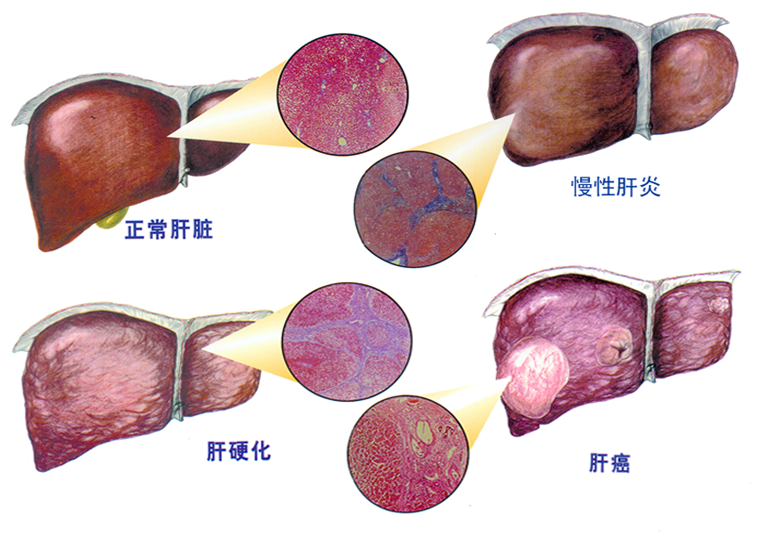 肝纤维化是什么病理组织结构